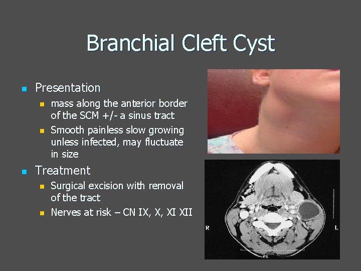 Branchial Cleft Cyst n Presentation n mass along the anterior border of the SCM