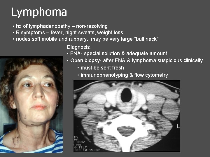 Lymphoma • hx of lymphadenopathy – non-resolving • B symptoms – fever, night sweats,