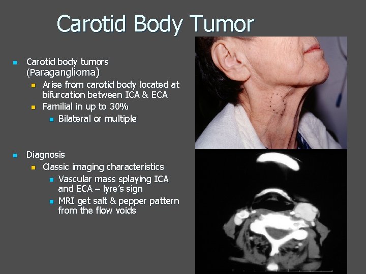 Carotid Body Tumor n n Carotid body tumors (Paraganglioma) n Arise from carotid body