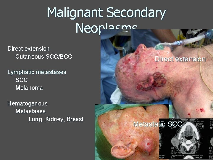 Malignant Secondary Neoplasms Direct extension Cutaneous SCC/BCC Direct extension Lymphatic metastases SCC Melanoma Hematogenous