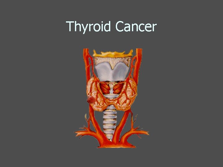 Thyroid Cancer 
