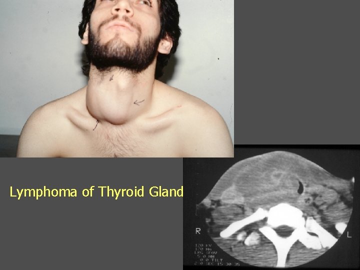 Lymphoma of Thyroid Gland 