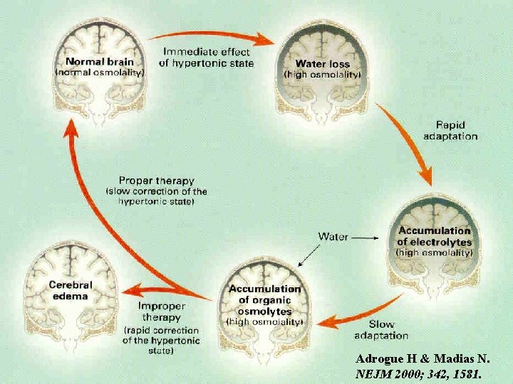 Adrogue H & Madias N. NEJM 2000; 342, 1581. Adrogue H & Madias N. NEJM 2000; 342, 1581.