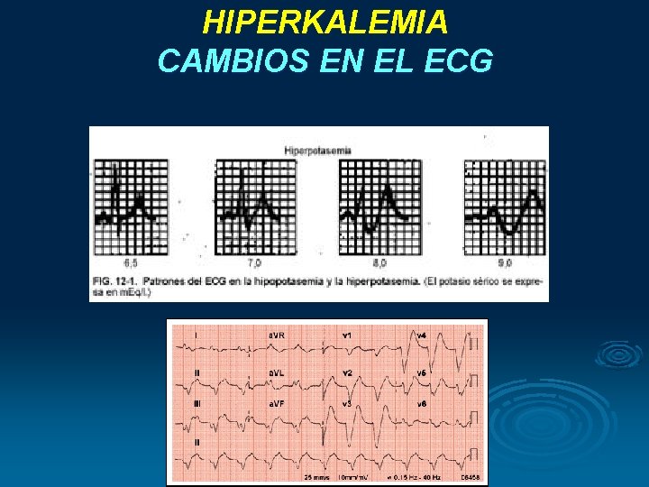 HIPERKALEMIA CAMBIOS EN EL ECG HIPERKALEMIA CAMBIOS EN EL ECG