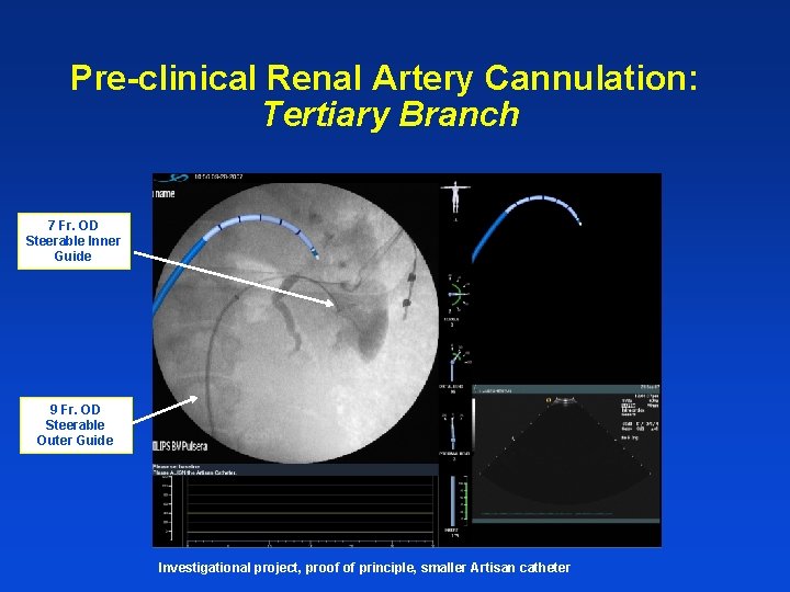 Pre-clinical Renal Artery Cannulation: Tertiary Branch 7 Fr. OD Steerable Inner Guide 9 Fr.
