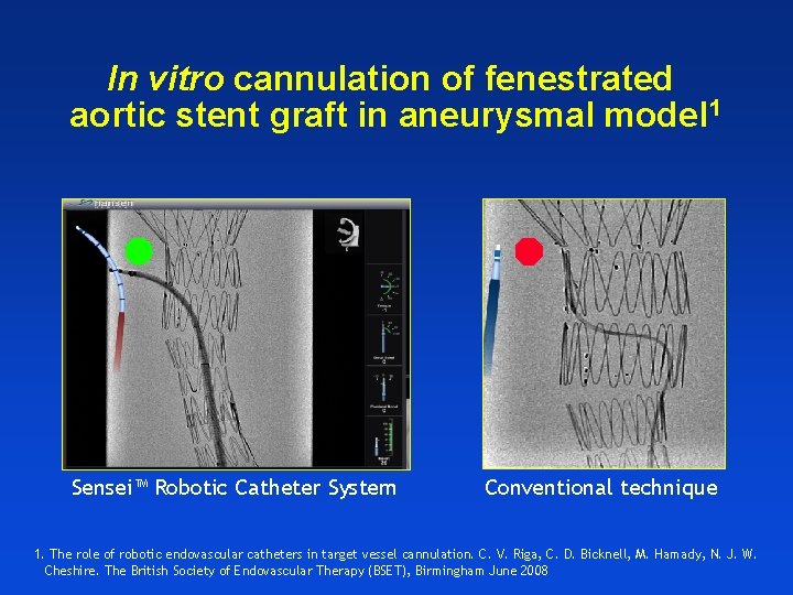 In vitro cannulation of fenestrated aortic stent graft in aneurysmal model 1 Sensei™ Robotic