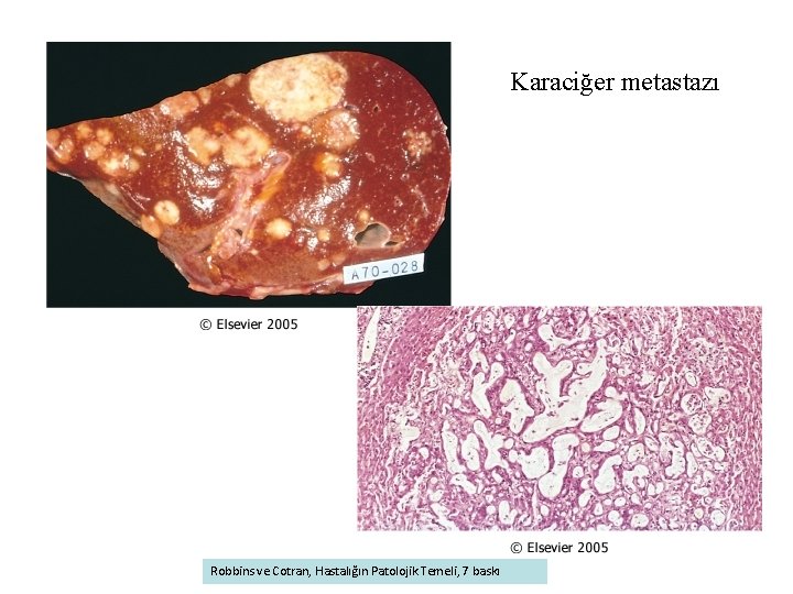 Karaciğer metastazı Robbins ve Cotran, Hastalığın Patolojik Temeli, 7 baskı 