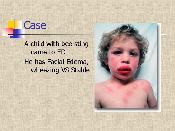 Case A child with bee sting came to ED He has Facial Edema, wheezing