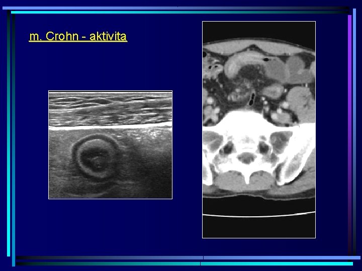 m. Crohn - aktivita 