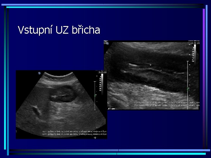Vstupní UZ břicha 
