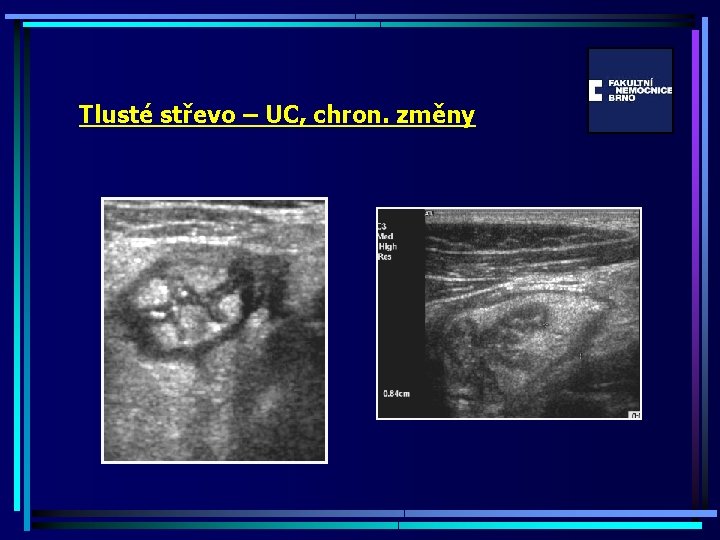 Tlusté střevo – UC, chron. změny 