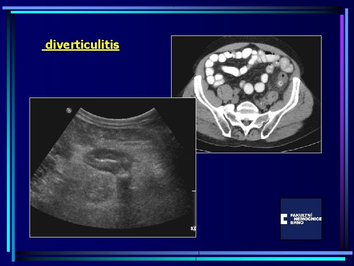 diverticulitis 