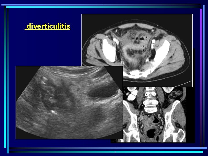 diverticulitis . 