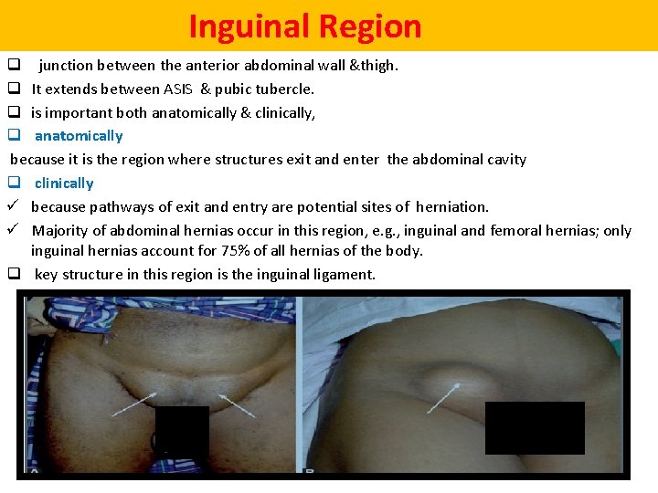  Inguinal Region q junction between the anterior abdominal wall &thigh. q It extends