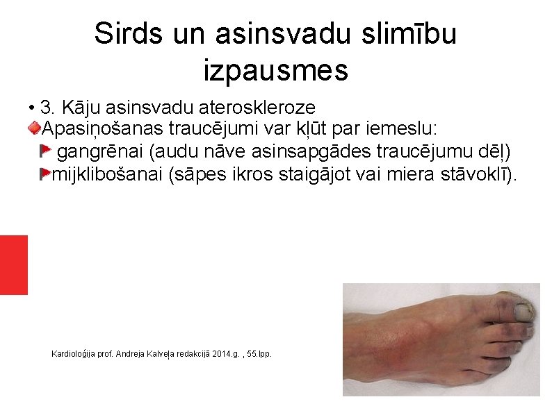 Sirds un asinsvadu slimību izpausmes • 3. Kāju asinsvadu ateroskleroze Apasiņošanas traucējumi var kļūt