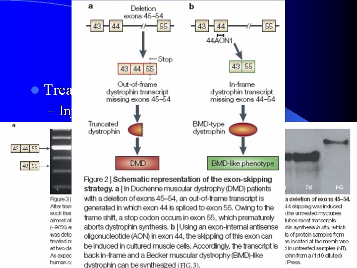 Duchenne Muscular Dystrophy l Treatment – Injection of liposomes into bloodstream l Good copy
