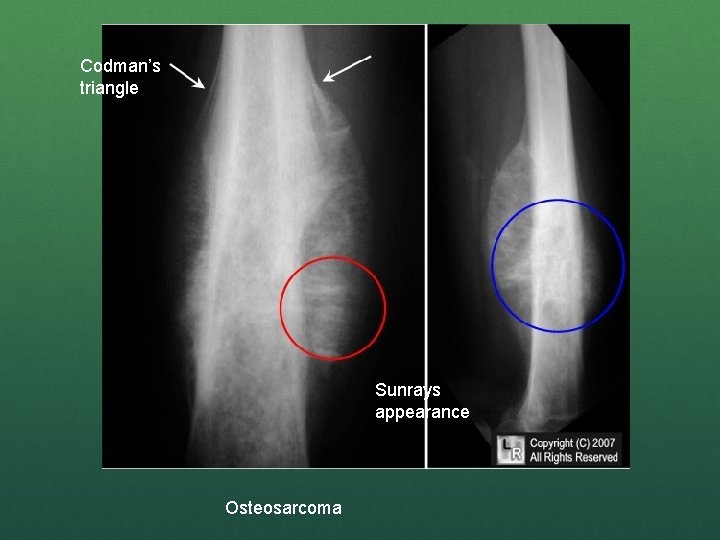 Codman’s triangle Sunrays appearance Osteosarcoma 