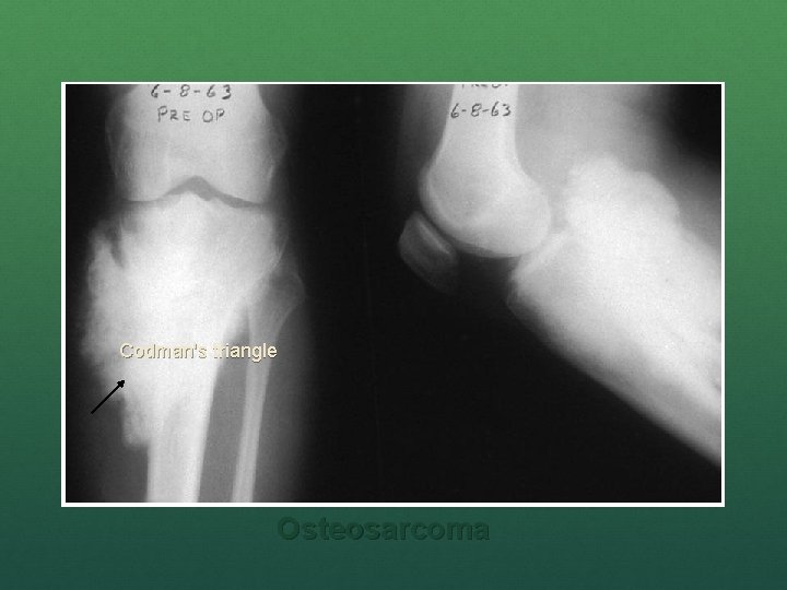 Codman's triangle Osteosarcoma 