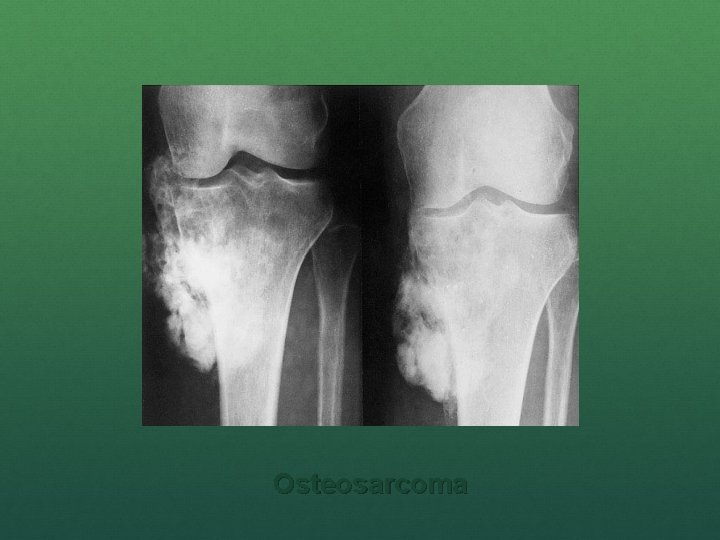 Osteosarcoma 
