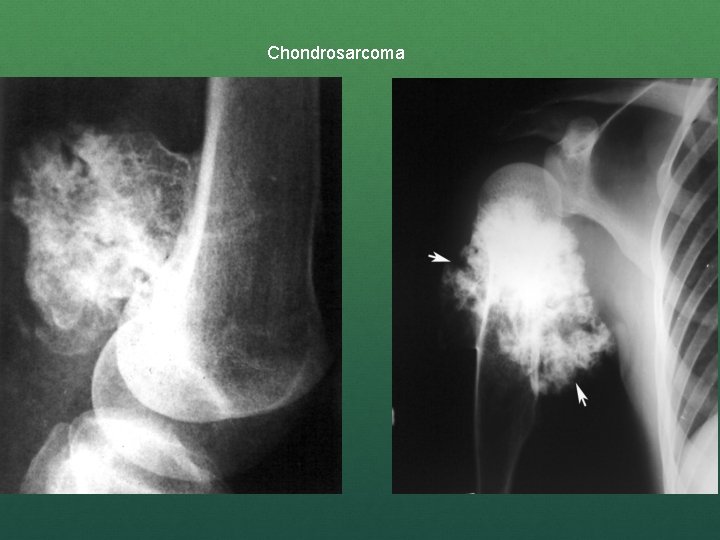 Chondrosarcoma 