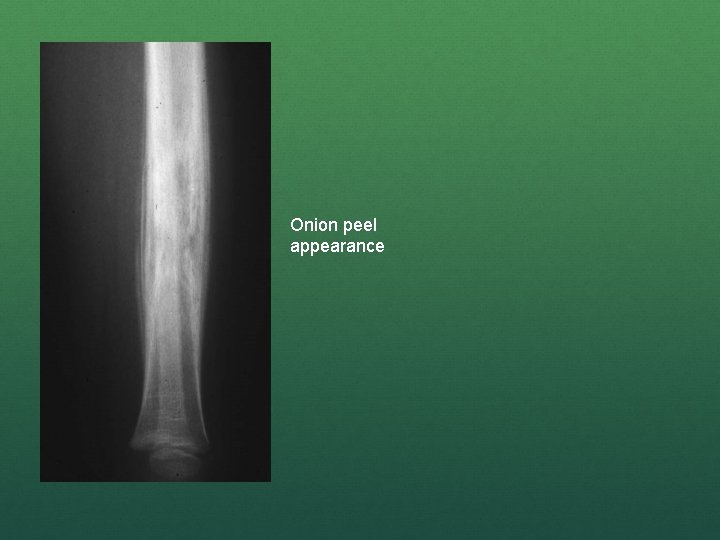 Onion peel appearance 