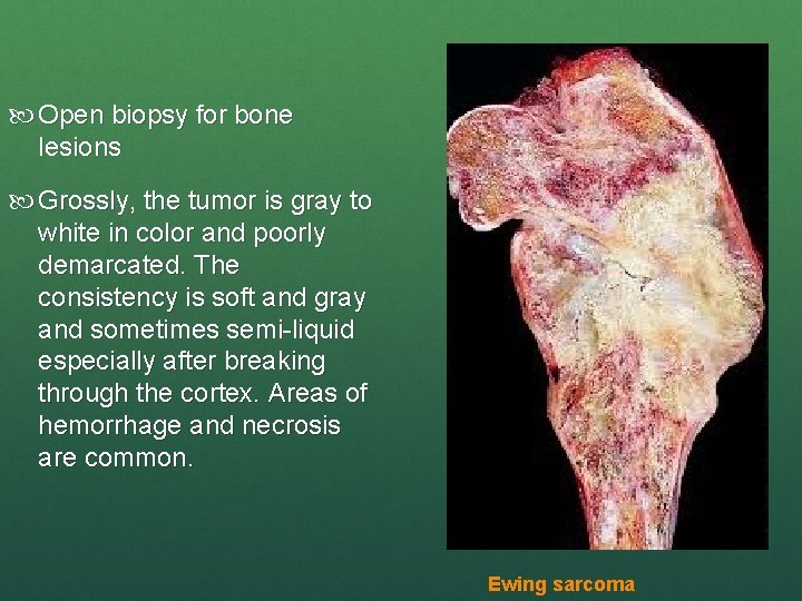 Open biopsy for bone lesions Grossly, the tumor is gray to white in
