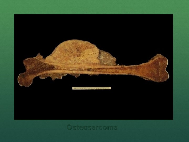 Osteosarcoma 