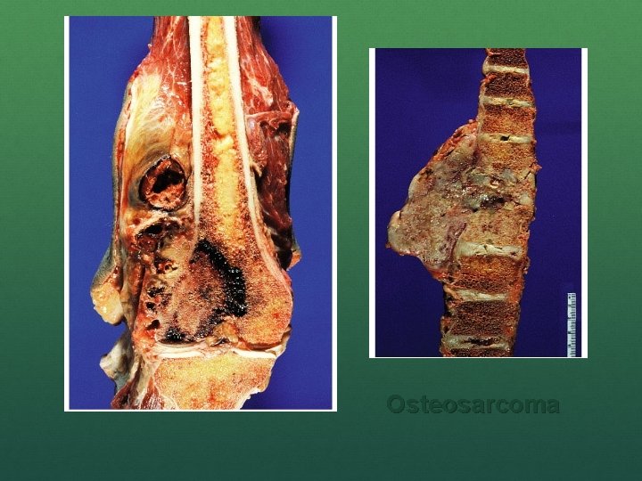 Osteosarcoma 