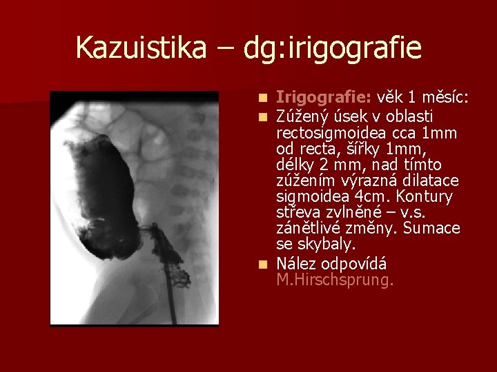 Kazuistika – dg: irigografie Irigografie: věk 1 měsíc: Zúžený úsek v oblasti rectosigmoidea cca