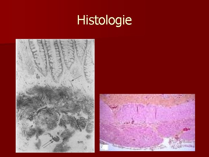 Histologie n Absence ggl. bb. v plexus submucosus Meisneri a plexus myentericus Auerbachi 