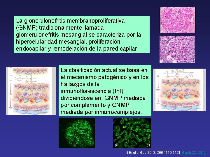 La glonerulonefritis membranoproliferativa (GNMP) tradicionalmente llamada glomerulonefritis mesangial se caracteriza por la hipercelularidad mesangial,