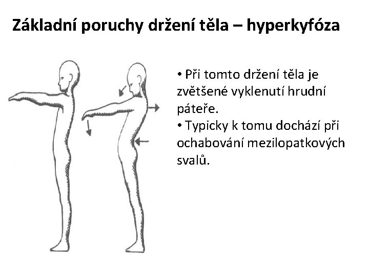 Základní poruchy držení těla – hyperkyfóza • Při tomto držení těla je zvětšené vyklenutí