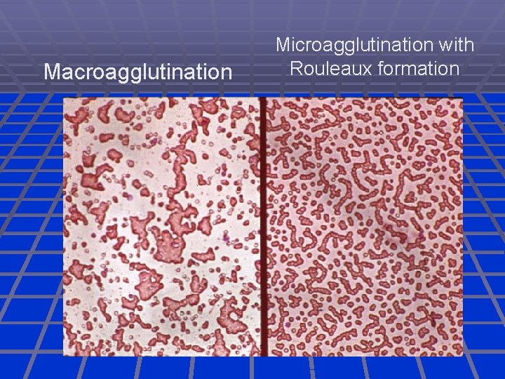 Macroagglutination Microagglutination with Rouleaux formation 
