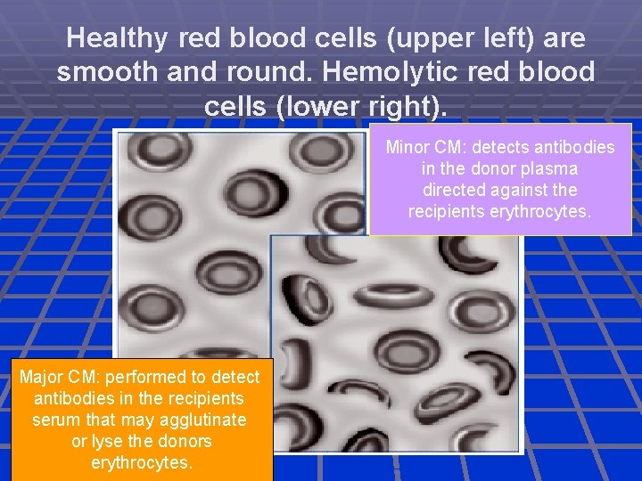 Healthy red blood cells (upper left) are smooth and round. Hemolytic red blood cells