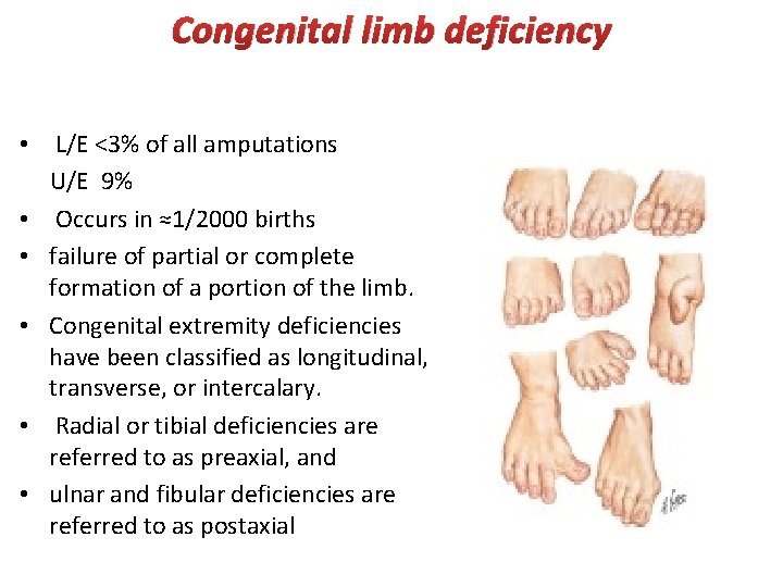 Congenital limb deficiency • L/E <3% of all amputations U/E 9% • Occurs in