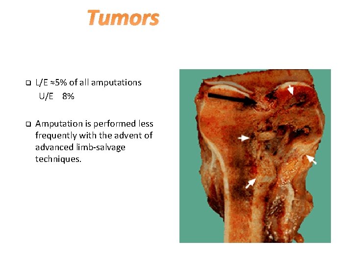 Tumors L/E ≈5% of all amputations U/E 8% q q Amputation is performed less