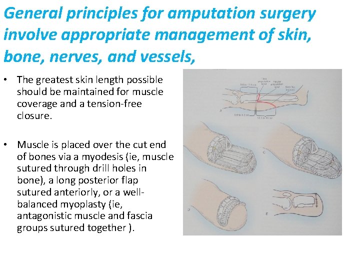 General principles for amputation surgery involve appropriate management of skin, bone, nerves, and vessels,