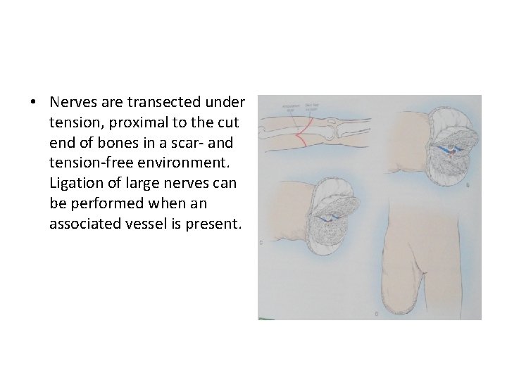  • Nerves are transected under tension, proximal to the cut end of bones