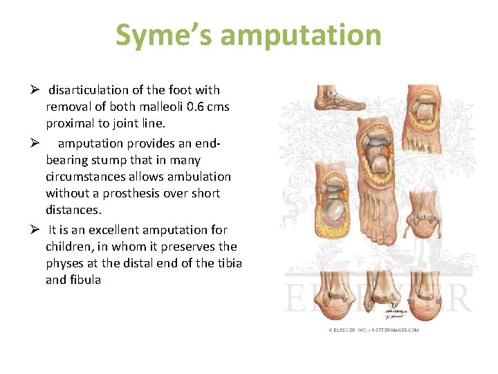 Syme’s amputation Ø disarticulation of the foot with removal of both malleoli 0. 6
