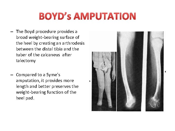 BOYD’s AMPUTATION – The Boyd procedure provides a broad weight-bearing surface of the heel