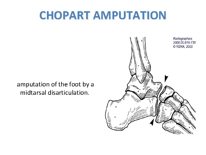 CHOPART AMPUTATION amputation of the foot by a midtarsal disarticulation. 