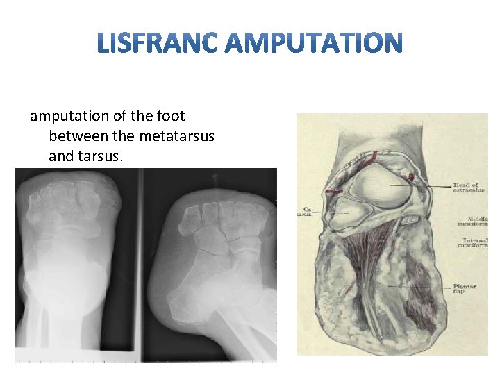 amputation of the foot between the metatarsus and tarsus. 