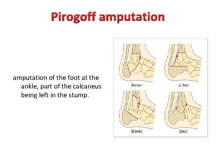 Pirogoff amputation of the foot at the ankle, part of the calcaneus being left