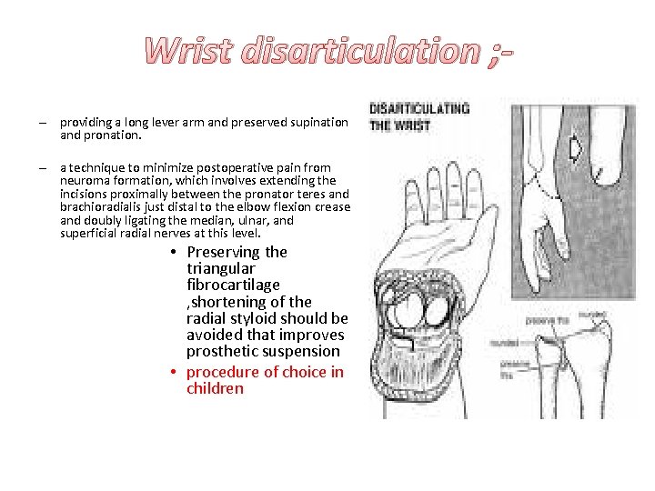 Wrist disarticulation ; – providing a long lever arm and preserved supination and pronation.