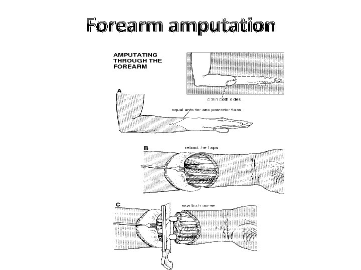 Forearm amputation 