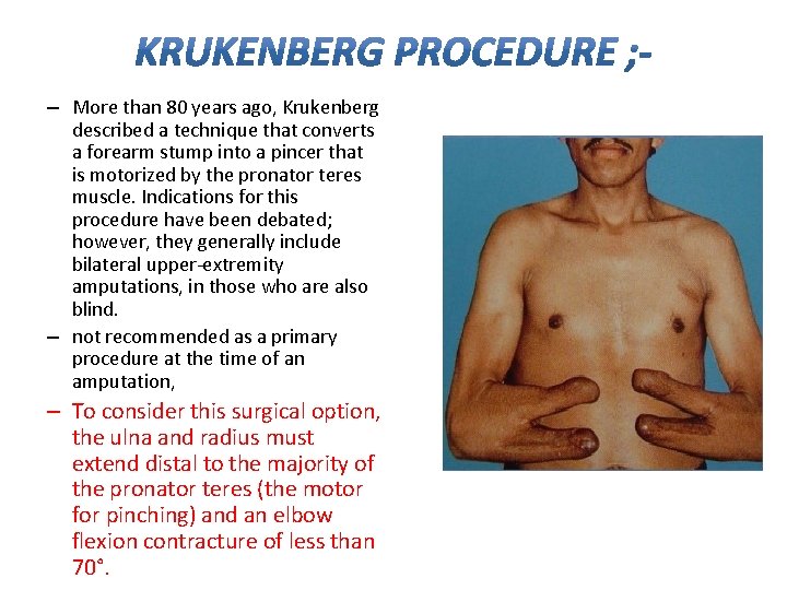 – More than 80 years ago, Krukenberg described a technique that converts a forearm