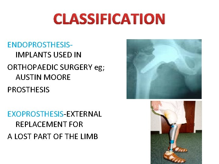 CLASSIFICATION ENDOPROSTHESIS- IMPLANTS USED IN ORTHOPAEDIC SURGERY eg; AUSTIN MOORE PROSTHESIS EXOPROSTHESIS-EXTERNAL REPLACEMENT FOR