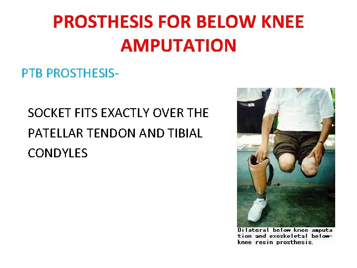 PROSTHESIS FOR BELOW KNEE AMPUTATION PTB PROSTHESIS SOCKET FITS EXACTLY OVER THE PATELLAR TENDON