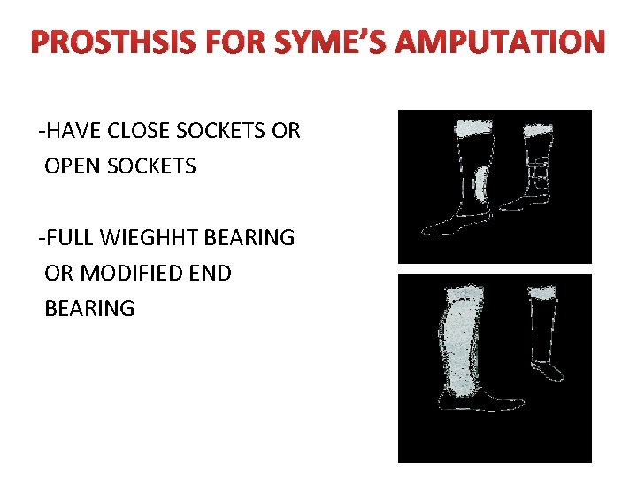 PROSTHSIS FOR SYME’S AMPUTATION -HAVE CLOSE SOCKETS OR OPEN SOCKETS -FULL WIEGHHT BEARING OR