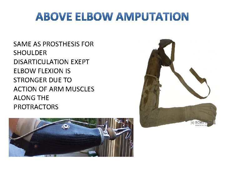 SAME AS PROSTHESIS FOR SHOULDER DISARTICULATION EXEPT ELBOW FLEXION IS STRONGER DUE TO ACTION